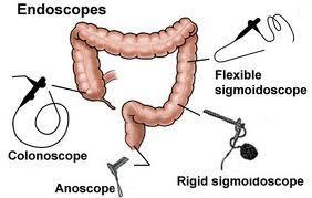 Screening Advancements Rigid Sigmoidoscopy Flexible