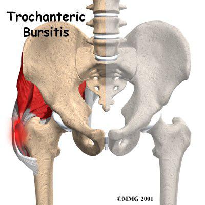 The greater trochanter is the large bump on the outside of the upper end of the femur. This bump is the point where the large buttock muscles that move the hip connect to the femur.