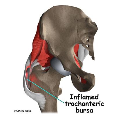 Most cases of trochanteric bursitis appear gradually with no obvious underlying injury or cause.