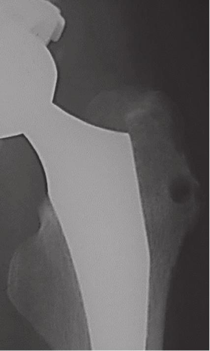 2 (d) Figure 1: Radiographs of the left hip joint after THA. The initial radiograph after THA. At 4 weeks after THA. At 8 weeks. (d) At 10 weeks.