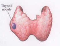 Most thyroid nodules are benign Thyroid nodules: new techniques in evaluation Incidence Etiology Risk factors Diagnosis Gene classification system Treatment Postgraduate Course in General Surgery