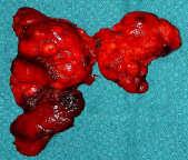 Gosnell MD May 18, 2013 (Tuttle and Lehoeuf, Endo Metab N Am) (ATA revised guidelines for Thyroid Nodules, Thyroid 2009) 2 Most thyroid nodules are benign thyroid nodules occur in 77% of the world s