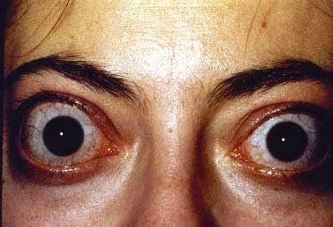 eye signs stare, lid lag, exophthalmos