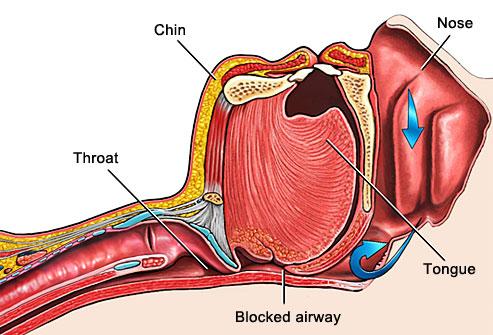 2.2 Obstructive Sleep Apnea OSA is regarded as the most common type of sleep apnea as it constitutes of about 84% of all patients diagnosed [72].