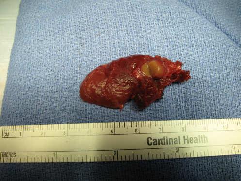 Protect excised parathyroid tissue from OR mishap Place in saline on ice Mince the most normal appearing gland into 1x2 mm fragments Transplant into individual muscle pockets in the nondominant