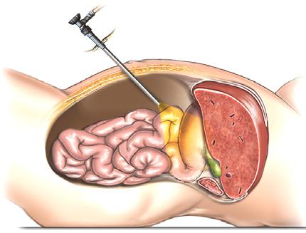 Your surgeon will make a small cut in or near your umbilicus (belly button) so they can insert an instrument which inflates the abdominal cavity with gas (carbon dioxide).