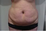 ABDOMINOPLASTY - TUMMY TUCK - PATIENT Nº 0017 25year old women who had a previous caesarian operation a year