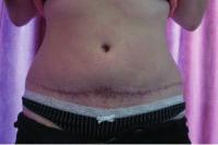Recovery was not straightforward as the patient had a reaction to the absorbable sutures, so the scars have been slow