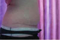 The New Tummy Tuck includes additional liposuction to flanks as standard, all sutures are dissolvable, there are no