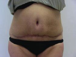 2kg of tissue (liposuction and excision of