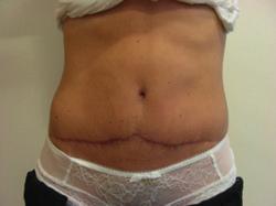 The New Tummy Tuck includes additional liposuction to flanks as