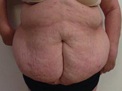 - APRONECTOMY MODIFIED BRAZILIAN TECHNIQUE FULL ABDOMINOPLASTY - APRONECTOMY - PATIENT Nº 0027 67yr old patient, who lost a 1/3