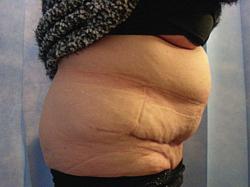 7litres of liposuction fat) This is NOT A COSMETIC BUT FUNCTIONAL OPERATION, the aim is to remove large amounts of redundant
