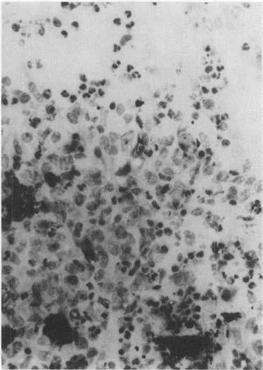 Fine-needle aspiration cytology of lepromatous leprosy 147 Plaques and nodular LL (14) Cellular smears.