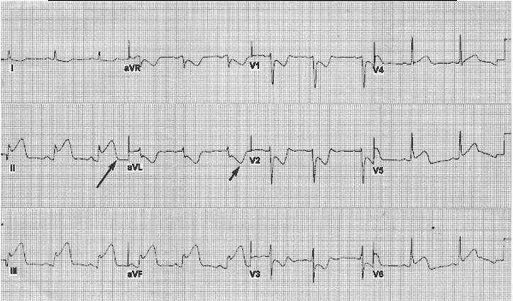 Does this patient have ACS? Troponin = 35 Objectives Improve speed and accuracy in assessing patients with possible ACS!