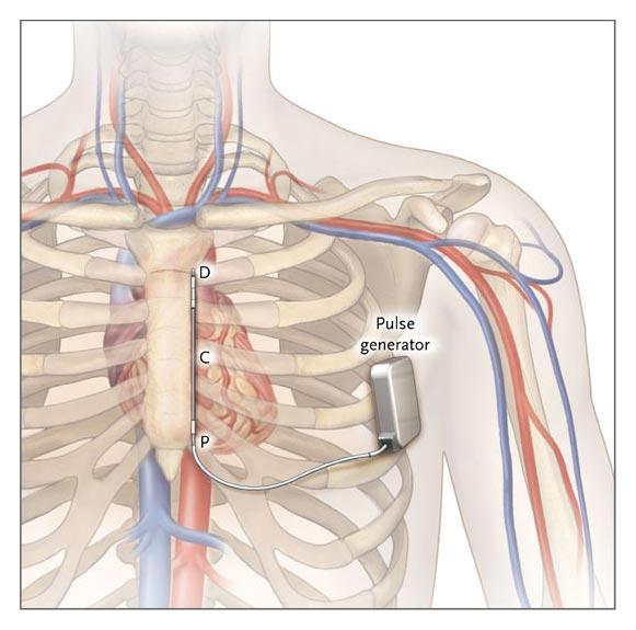 SUBCUTANEOUS ICD Indications Current indication for ICD implantation Not suited for pts who need Pacing for bradycardia Pacing for VT CRT Initial target