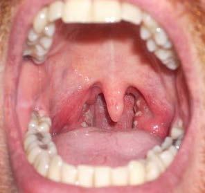 Pharyngeal Gonorrhea Relatively