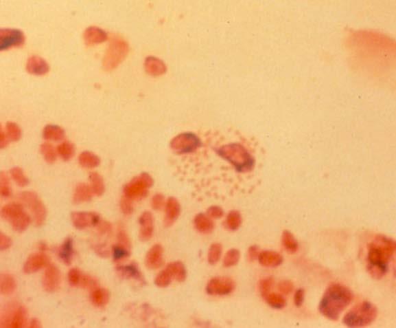 Cause : Neisseria gonorrhoeae Gram stain : Gram-Negative