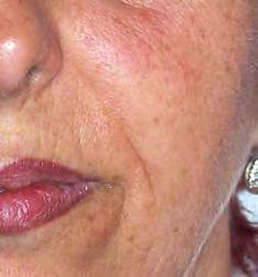 The notorious deep nose/cheek wrinkles, drooping jowls, sagging skin below the chin, forehead wrinkles and fine