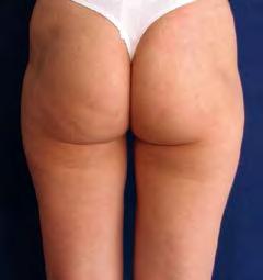 elasticity 1 Christ, C. et al.: Improvement in skin elasticity in the treatment of cellulite and connective tissue weakness by means of extracorporeal pulse activation therapy.