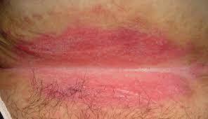 Caustic Moisture Damage: Stool/Urine Inflammation of the skin that occurs
