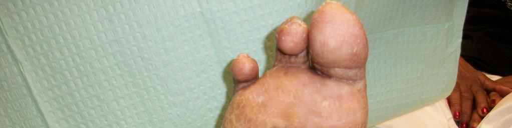 Grade 0: No ulcer in a high risk foot Grade 1: