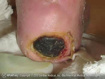 Unstageable/Unclassified Full thickness skin or tissue loss-depth unknown Depth is obscured by slough (yellow, tan, gray, green or brown) and/or eschar(tan, brown or black) in the wound bed Cannot