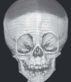 Figure 1 Figure 2 Preoperative planning The patient underwent a CT scan of the head and