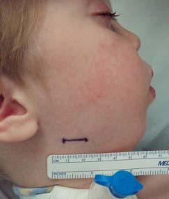 Surgical treatment Bilateral 2 cm incisions were made along the angle of the mandible (Figure 5).
