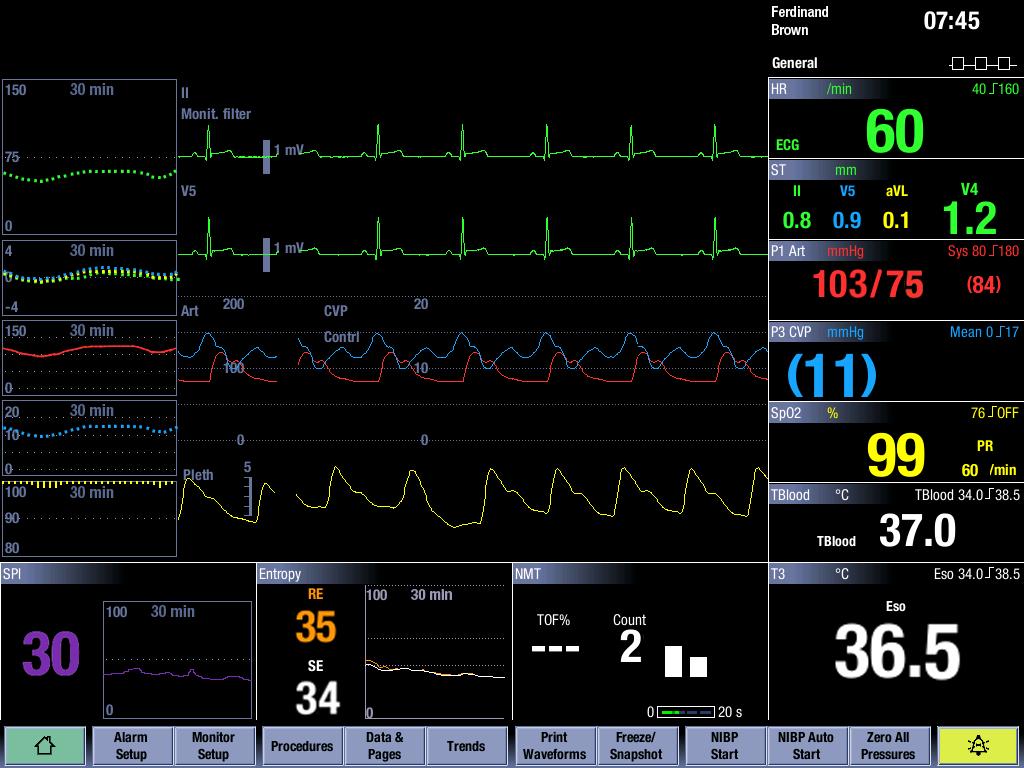 SpO2 technology SPI reflects the patient s hemodynamic responses to surgical stimuli and