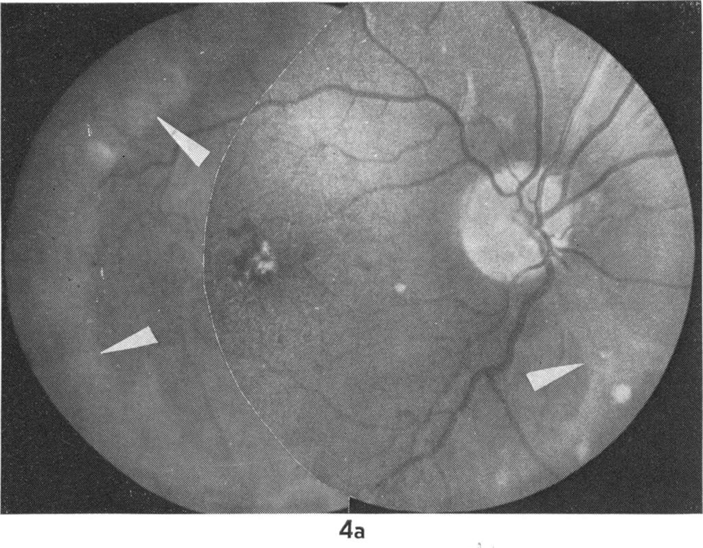 610 Table 2 Late manifestations of neonatal herpes simplex virus infection Visual acuity Refraction Case Righ/t eye Lejt eye Rig/it eye Leli eye General commiiiienits Lens Rigl/t eye 1 05 05 1-50 T 1