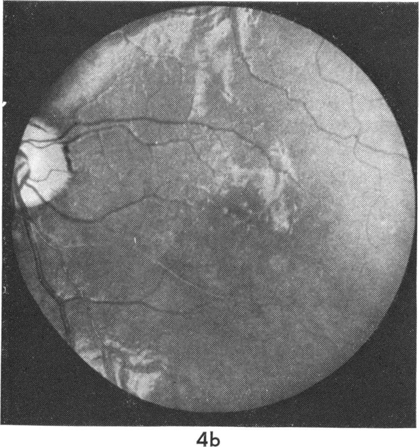 )ptic disc Right eye Late ocular manifestations in neonatal herpes simplex inifection Pale, anomalous almost like coloboma Left eye Retinia Right eye Left eye Atrophy of the pigment epithelium around