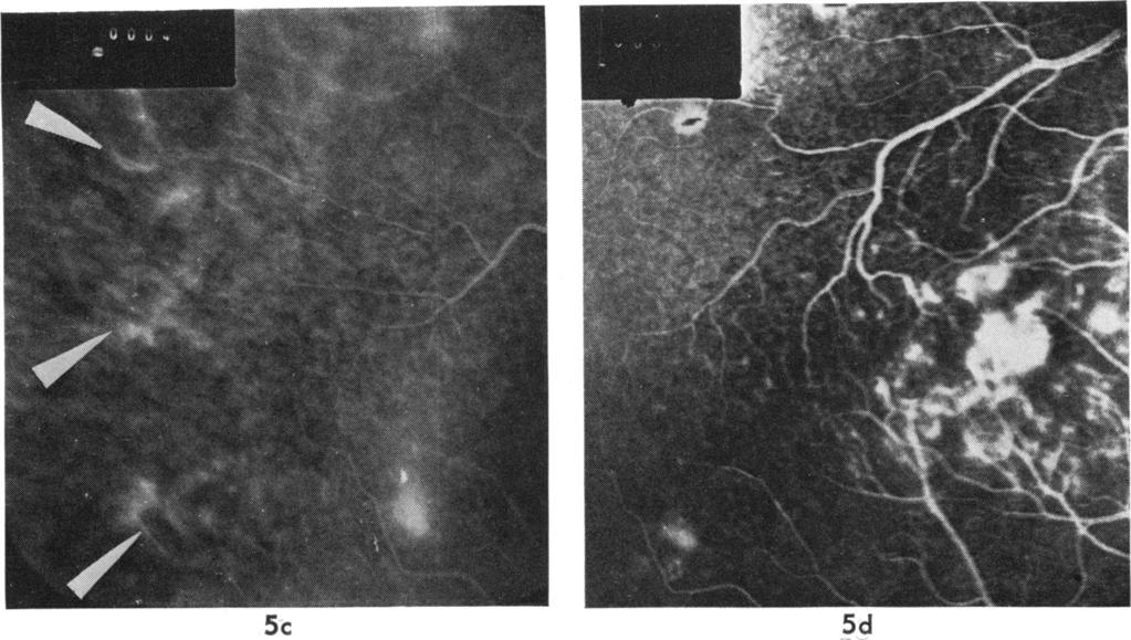 Late ocular manifestations in neonatal herpes simplex infection 5c Fig. 5a-f Case 4 Right eye.