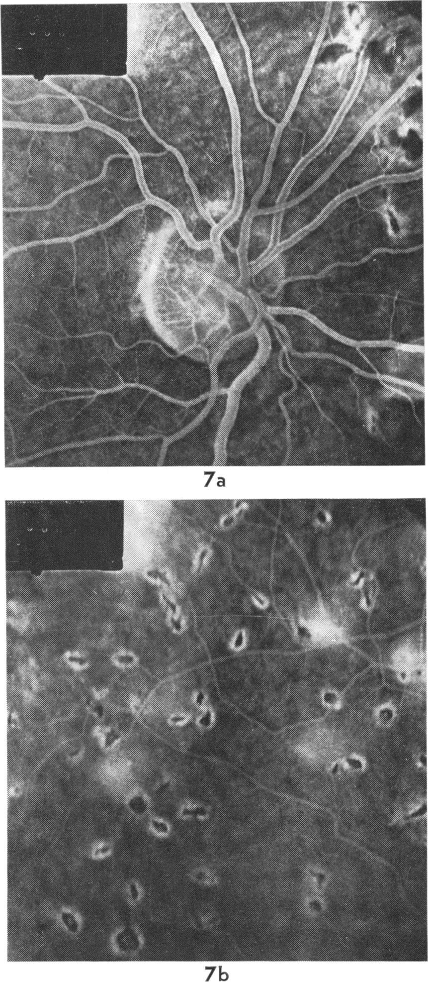 Late ocular manifestations in neonatal herpes simplex infection Oc Fig. 6a-e Case 4 Left eye. Good view of choroidal fluorescence even in the macular area (a).