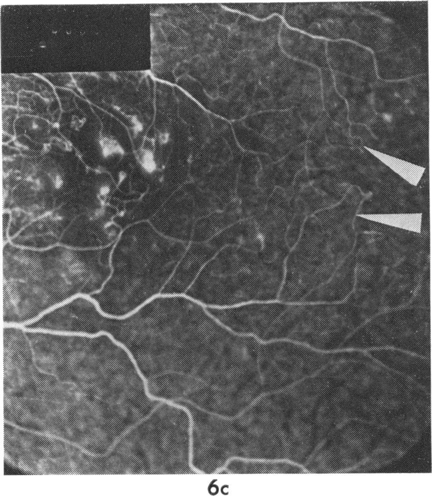 (c, d) Several arteriovenous communications (arrows) on the margin of the avascular retina temporal to the macula. (e) Leaking areas along the course of the inferotemporal veins (arrows) 615 Fig.