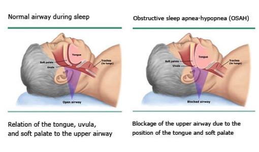 Obstructive Sleep Apnea Airway in a person with sleep apnea.