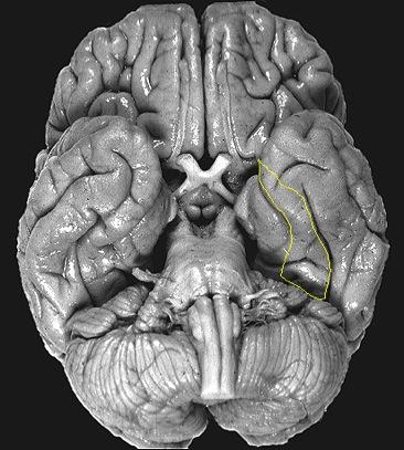Fusiform gyrus Occipitotemporal