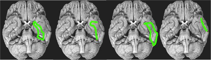 gyrus Inferior temporal cortex
