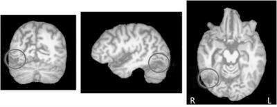Pa%ent Work/Brain Lesions Visual Agnosias 1890 Studies of brain lesions
