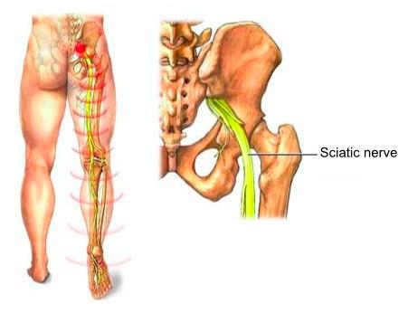 Diagnosing a Herniated Disc Sciatica is a condition where the sciatic nerve is being irritated or pinched by a herniated disc in the low back.