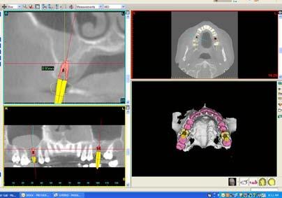 The planning software allows you to drop in virtual teeth into the edentulous area.