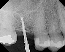 5. A digital radiograph is taken to determine angulation of the