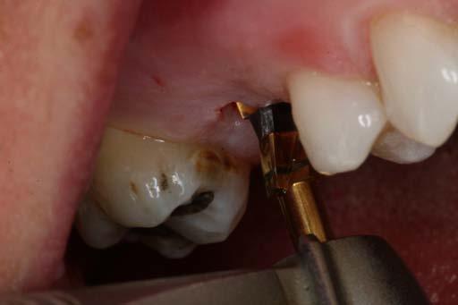 Note the gingiva was approximately 3 mm in height, so in determining a visual of how deep to place the
