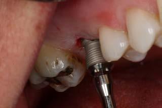 12. Final seating and the tightness of the implant in bone is accomplished with the