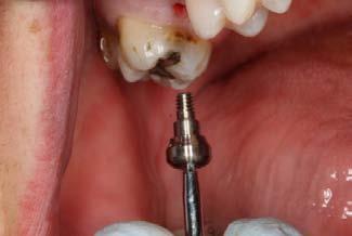Either a cover screw or a taller healing abutment can be safely placed into the implant