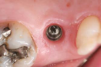 The healing abutment is removed from the implant.