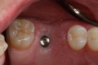 the proper abutment and crown. 25. The healing abutment is removed.
