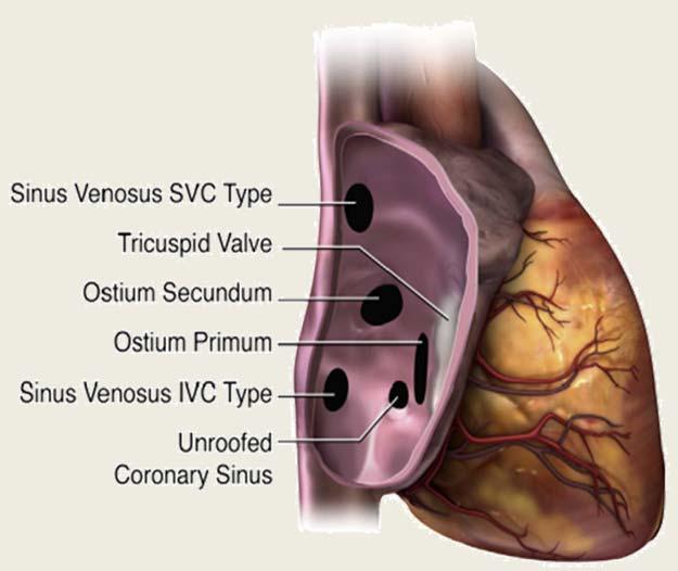 SUBTYPES OF ATRIAL SEPTAL COMMUNICATIONS