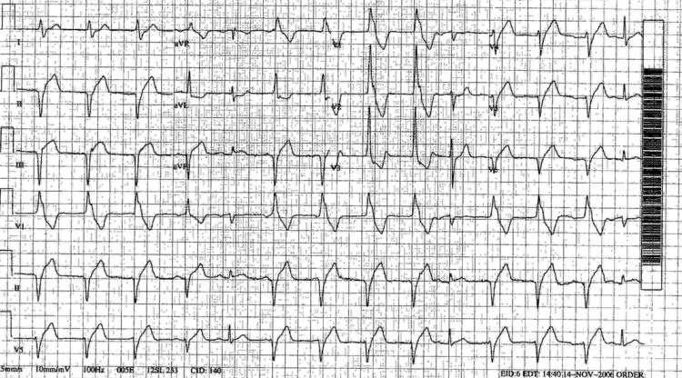 Ventricular Arrhythmias 60-110 BPM; Up to 20% STEMI patients have this Usually a result of reperfusion; no specific therapy needed if HD stable.