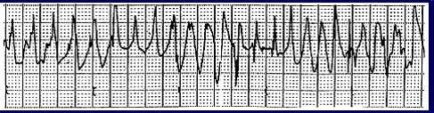 Not So Benign Rhythm Ischemic VT is often polymorphic; HR>100-110 BPM Higher risk with more LV damage and in